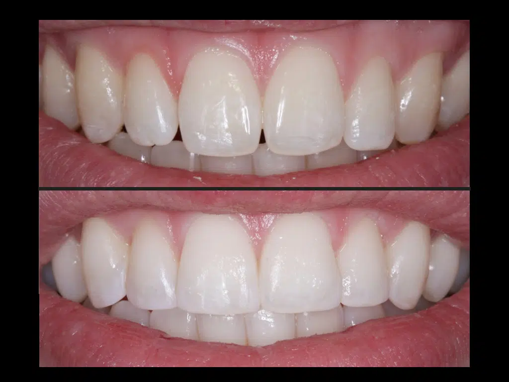 Composite veneers before and after in Formby and Liverpool