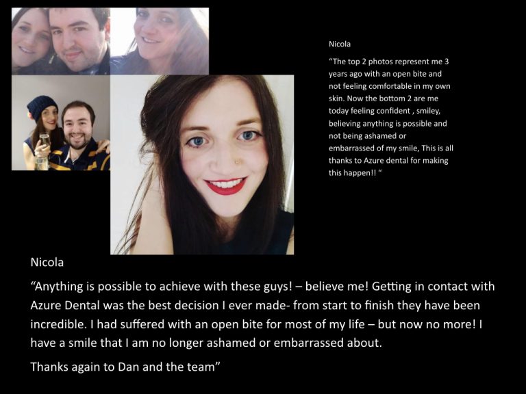 Nicola — Azure Dental brace patient testimonial