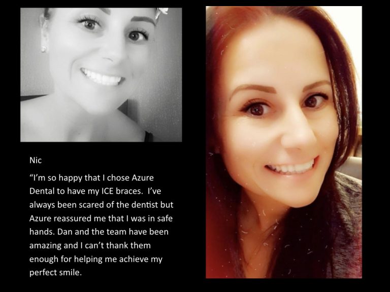 Azure Dental brace patient testimonial
