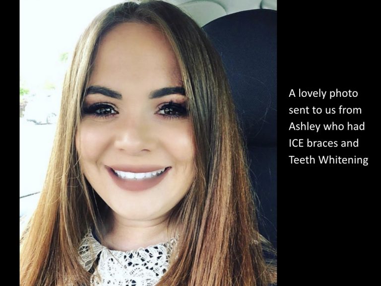 Azure Dental brace patient testimonial