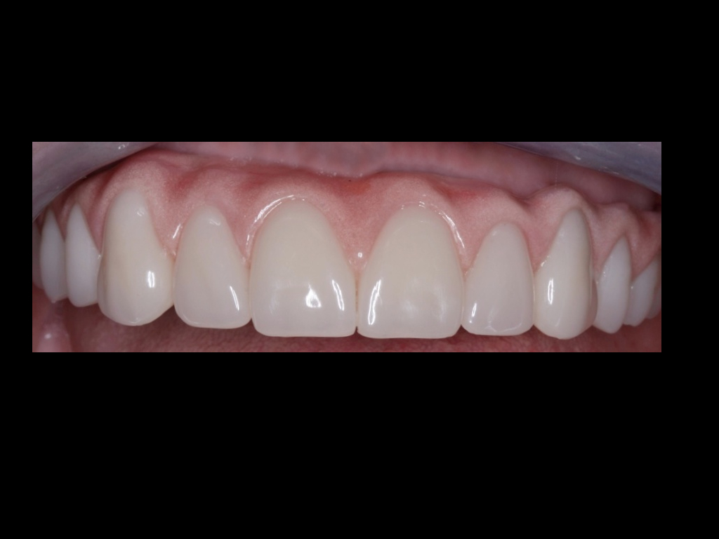 ALLON4 SAME DAY TEETH LIVERPOOL Azure Dental Clinic