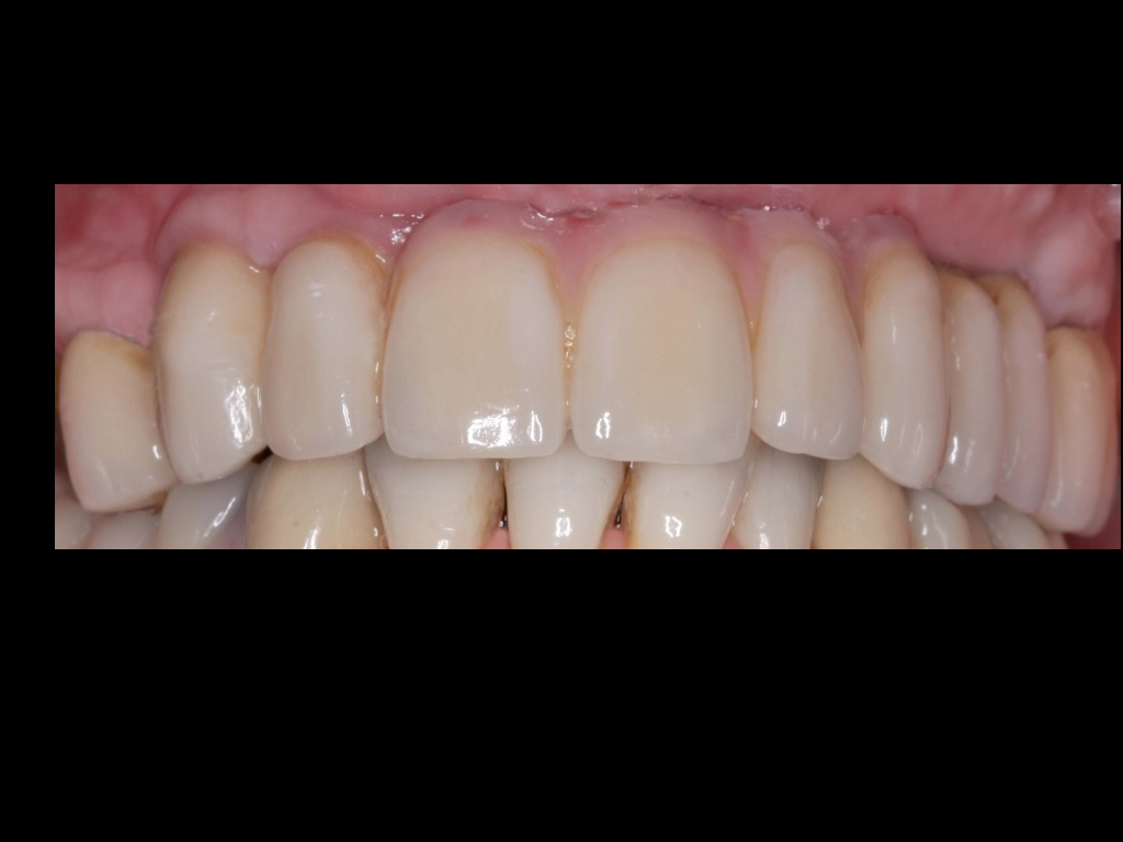 Upper Porcelain All-on-4 bridgework