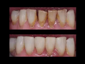 Close-up cosmetic smile enhancement treatment result
