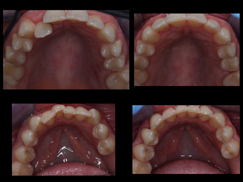 images of completed teeth straightening