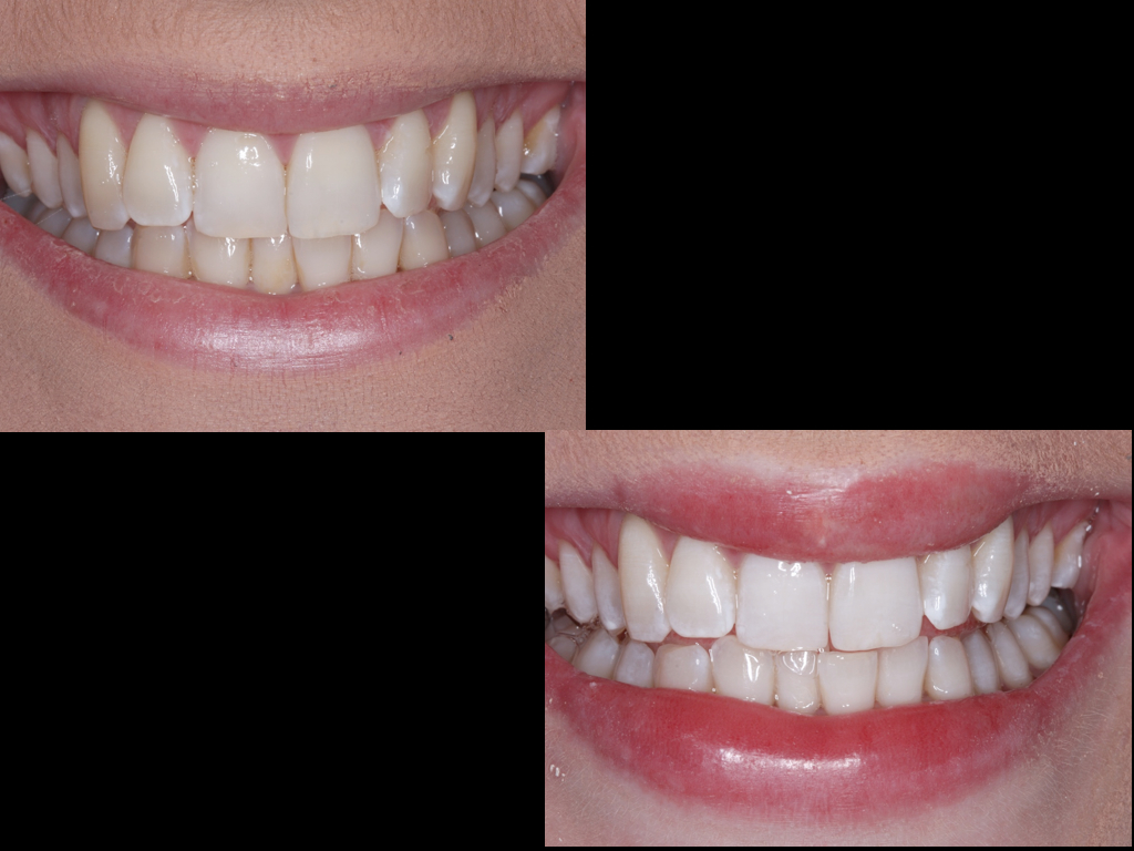 Patient whitening improvement