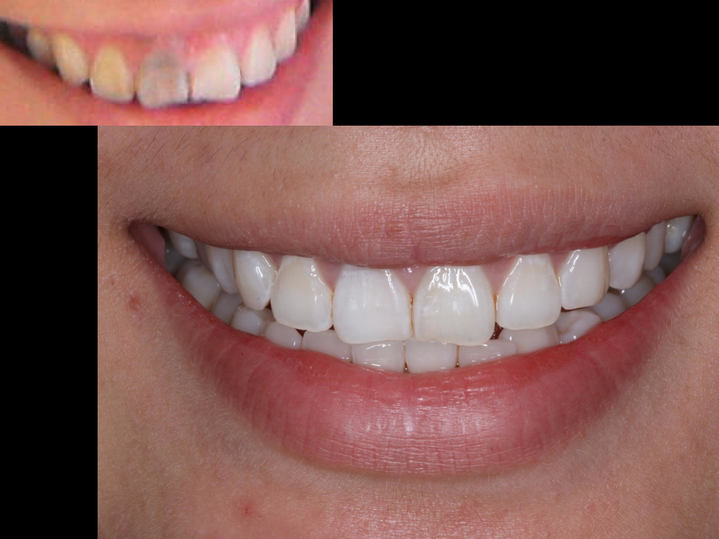 Composite Bonding in Liverpool Same Day Smile Makeover Azure Dental