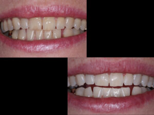 Laser Tooth Whitening