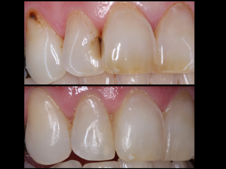 Replacement white fillings at the Woolton Dentist