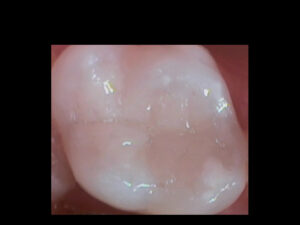 photo of a beautiful carved white filling placed by a Formby Dentist