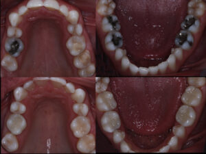 comparison between white fillings and silver fillings