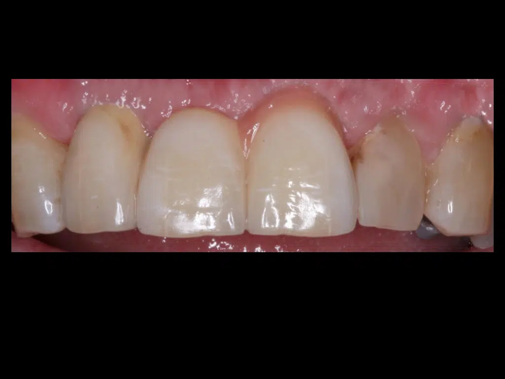 Implant bridgework Liverpool
