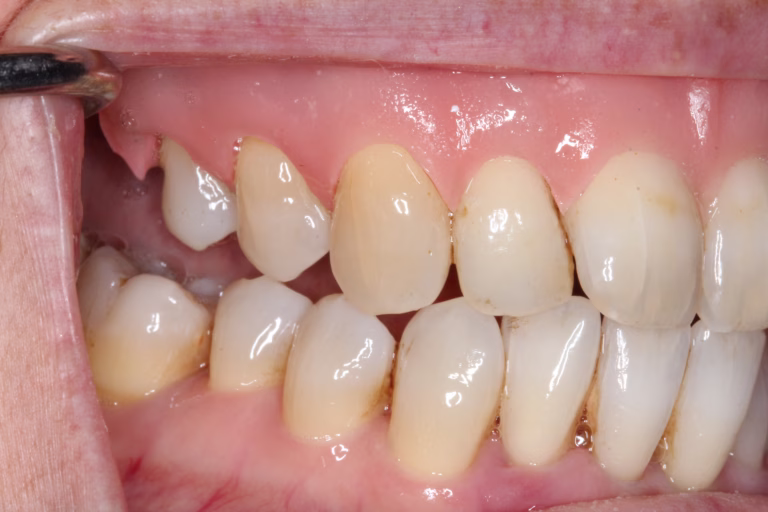 After gingival gum veneers Liverpool – right view
