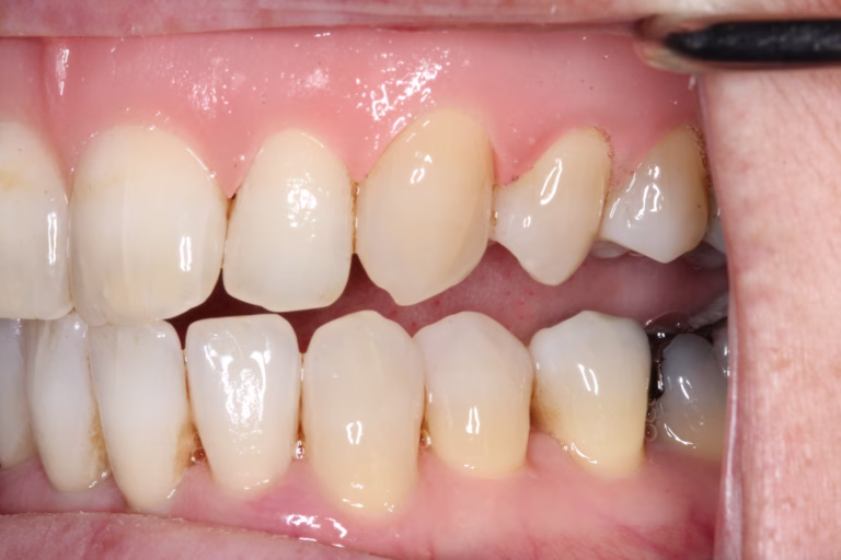 After smile – left view