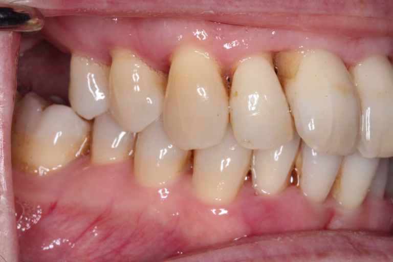 Before smile – right side