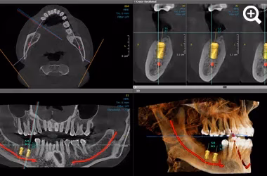 Digital planning for dental implants in Crosby using CBCT imaging