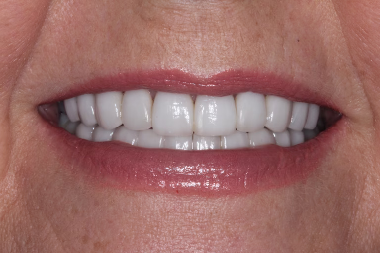 After image of a full smile makeover using Porcelain veneers