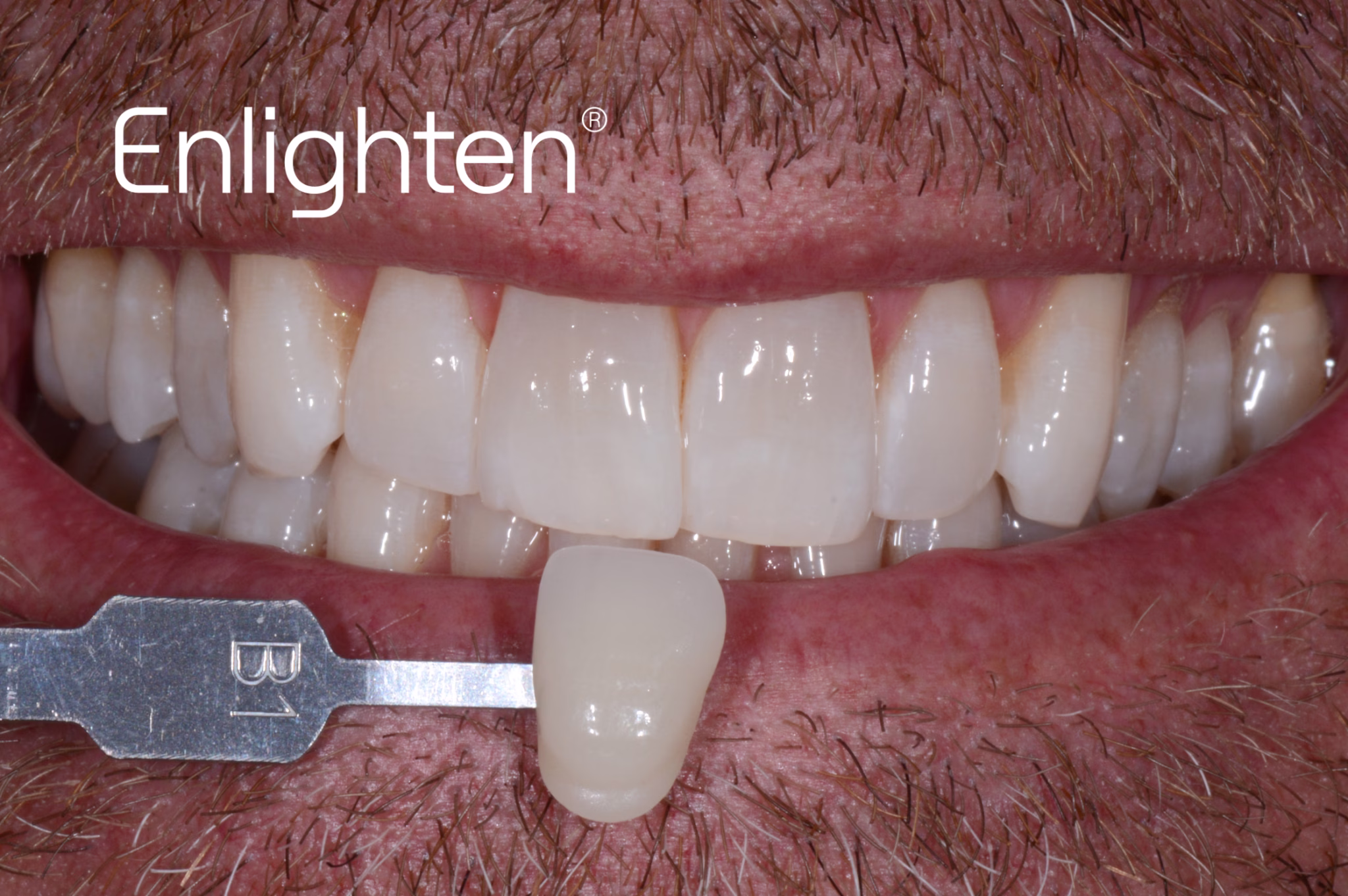 Natural bright whitening result case 4