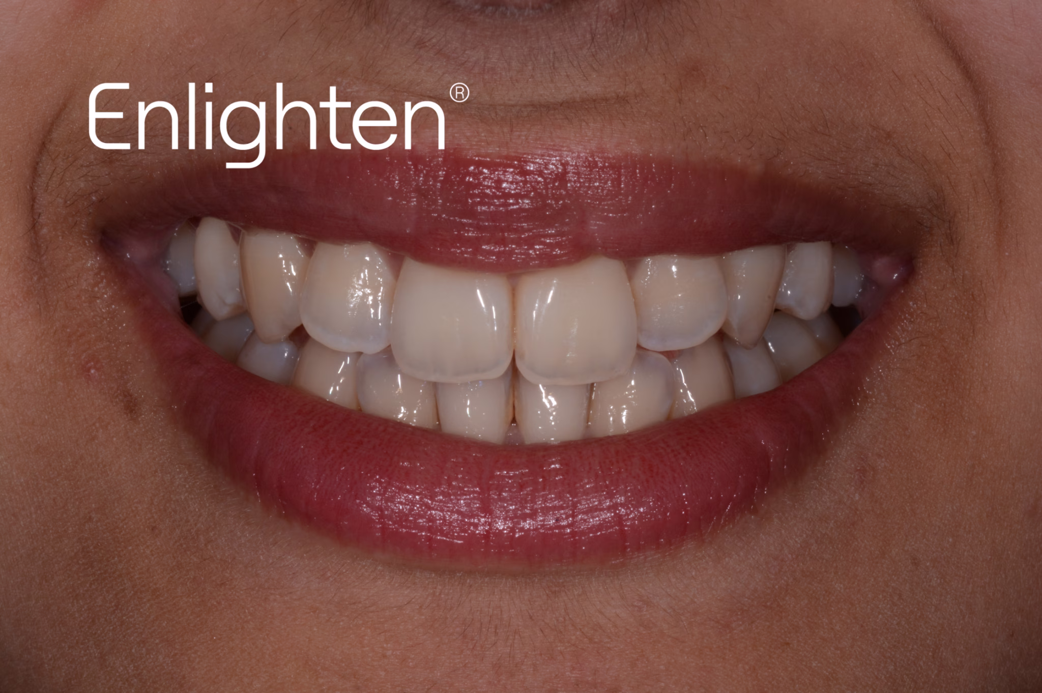 Before whitening case 3