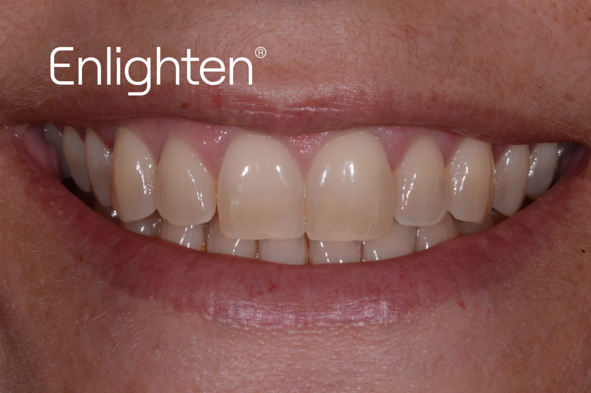 Teeth whitening before case 2