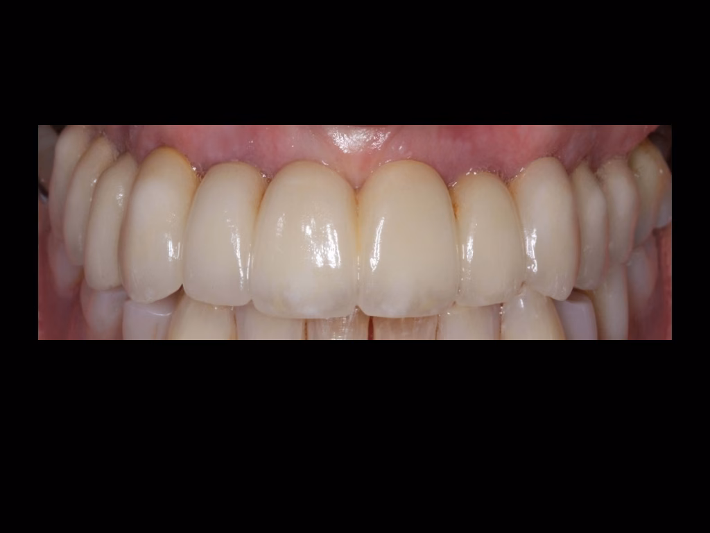 A final post treatment picture of an upper zygomatic Implant Bridge