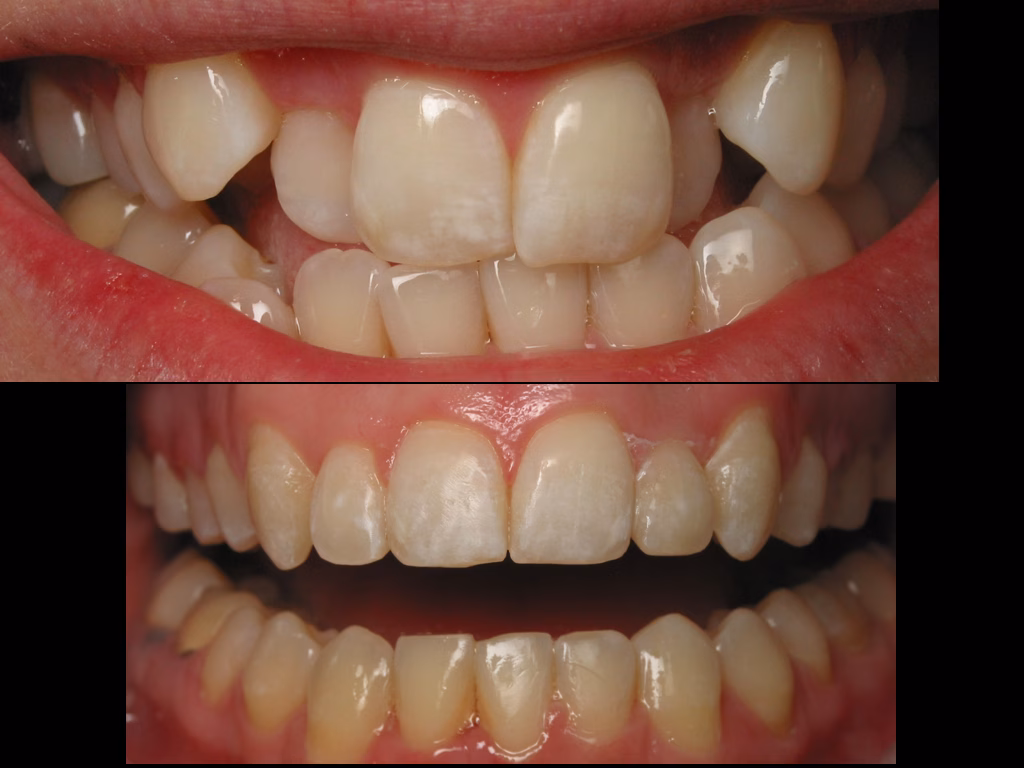 Fixed braces Southport – cosmetic ceramic brackets case 02