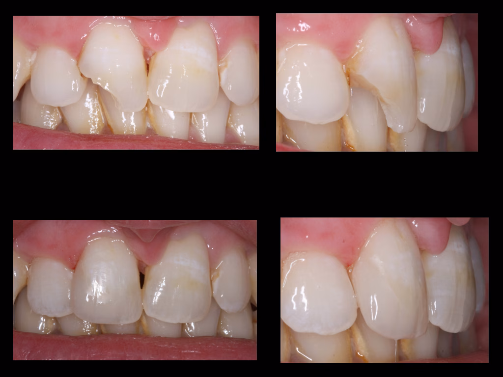 Close-up of natural-looking white fillings for front teeth in the smile zone