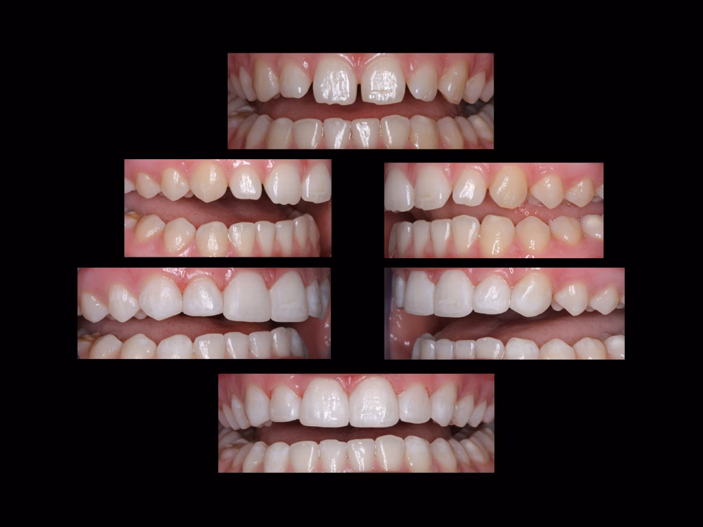 Composite bonding smile result in Formby