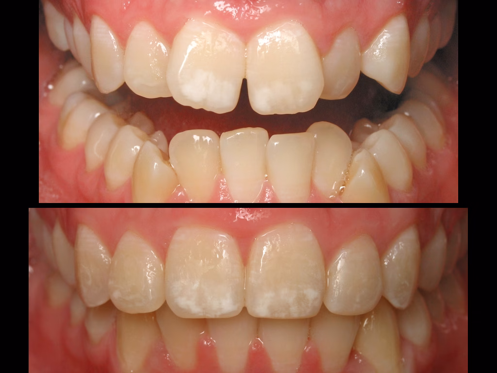 Cosmetic ceramic braces before after