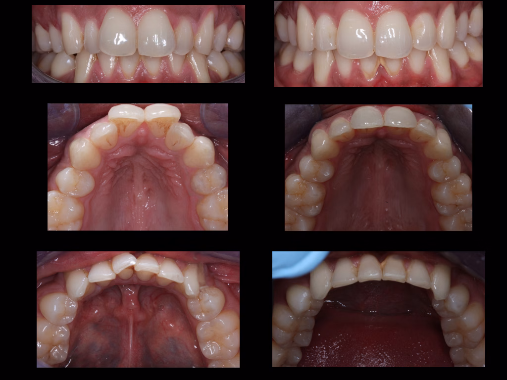 Teeth straightening Liverpool clear aligners result