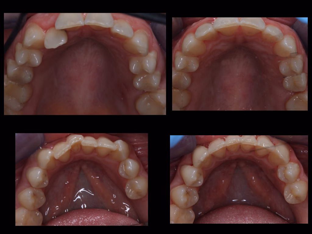 Invisalign UL2 instanding result