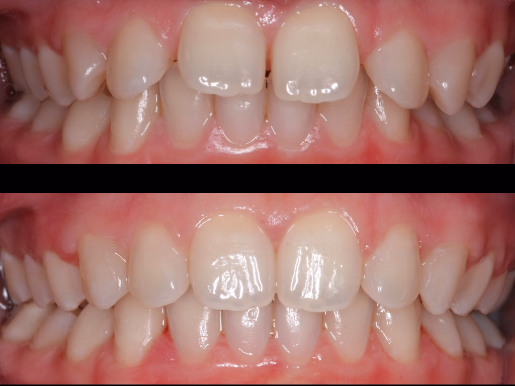 Spacing correction case