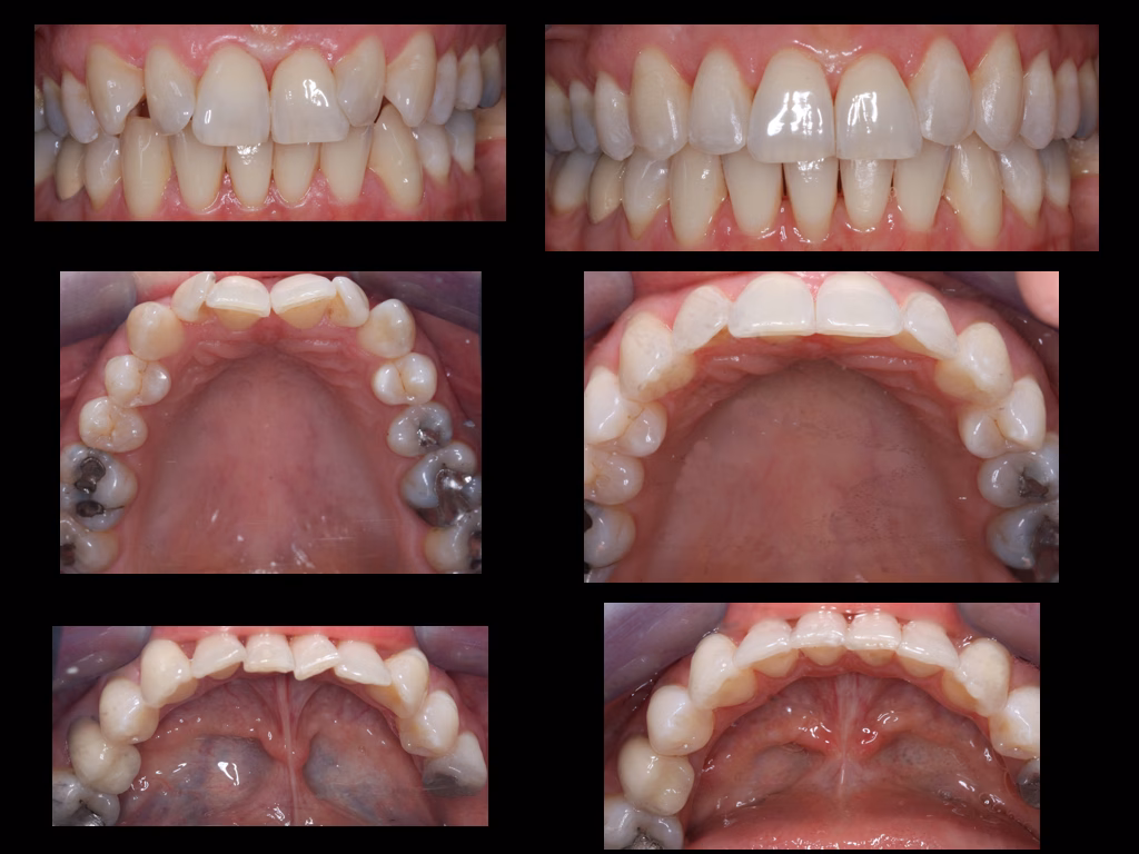Invisalign Liverpool clear aligners at Azure Dental