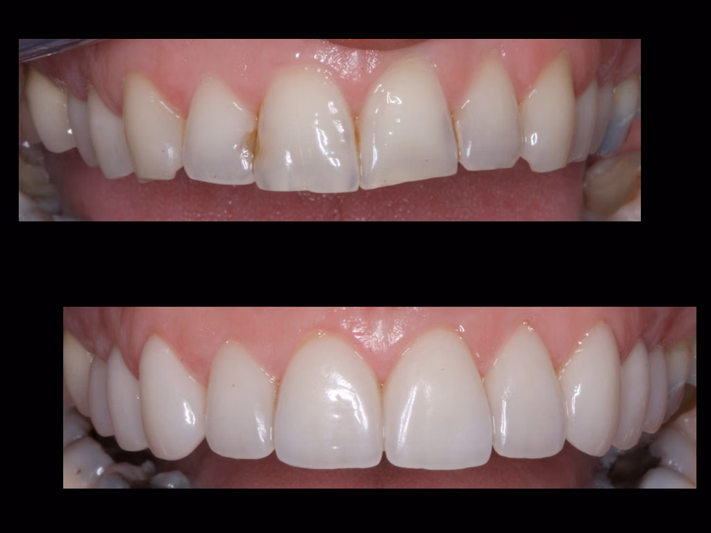 Digital planning preview for smile design