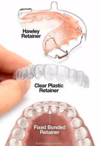 An image showing the different types or orthodontic retainers. One Hawley retainer, one Essix clear retainer and one fixed bonded retainer