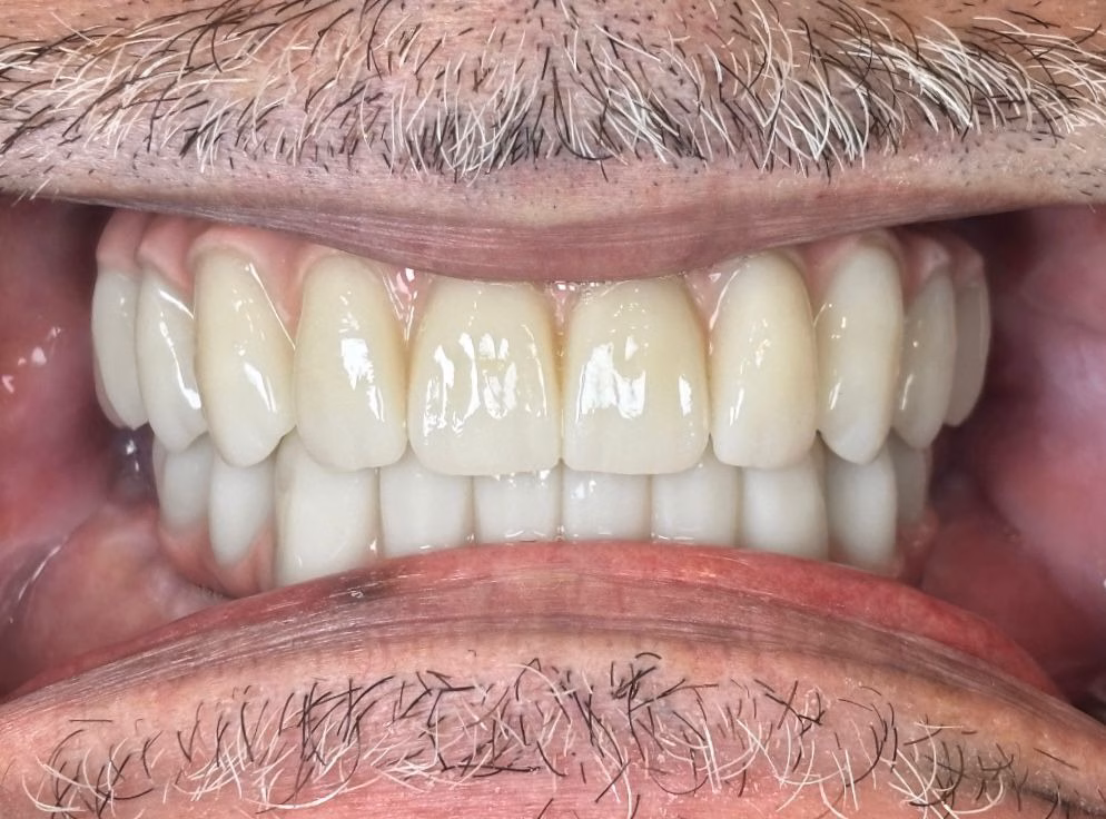 Image of a patient smiling with his new upper and lower All-on-4 Zirconia bridgework completed