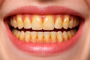 Can yellow teeth be whitened? Whitening advice from a Formby dentist (near Liverpool)