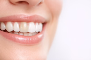 Teeth that cannot be whitened: crowns, veneers and fillings can look darker after whitening natural teeth